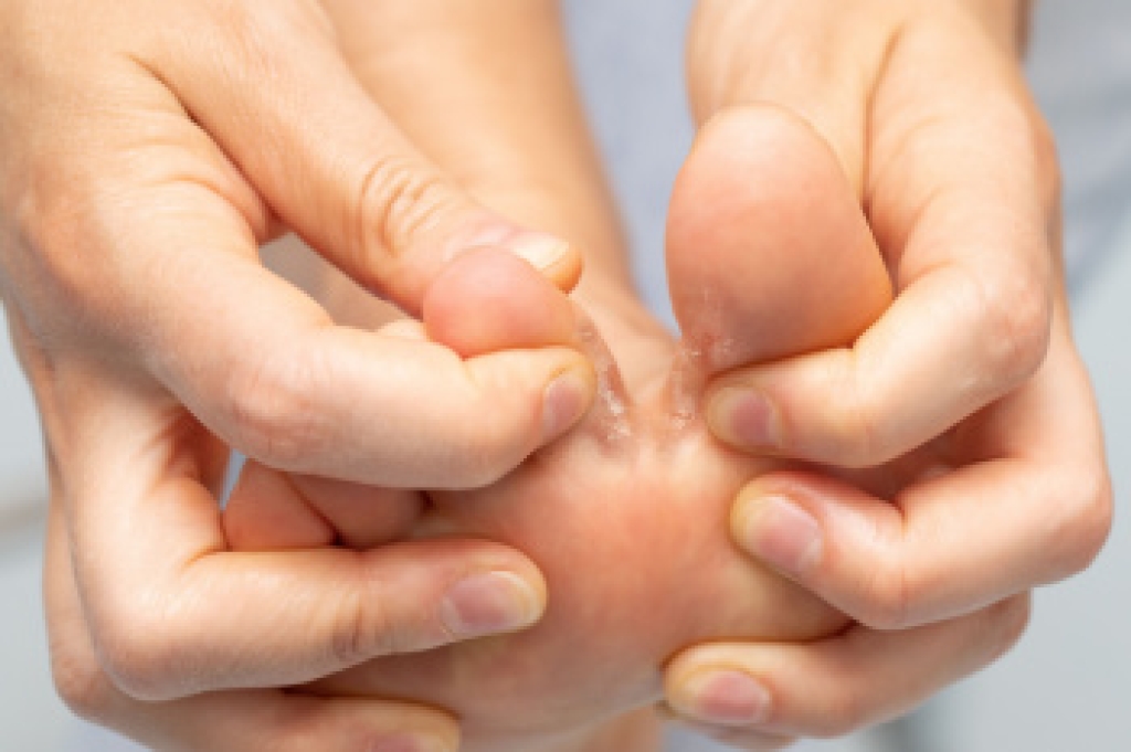 Recognizing the Warning Signs of Athlete's Foot