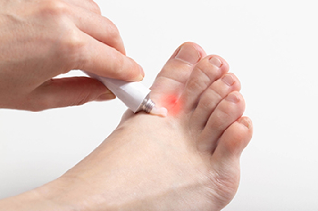 What to Know About Athlete’s Foot