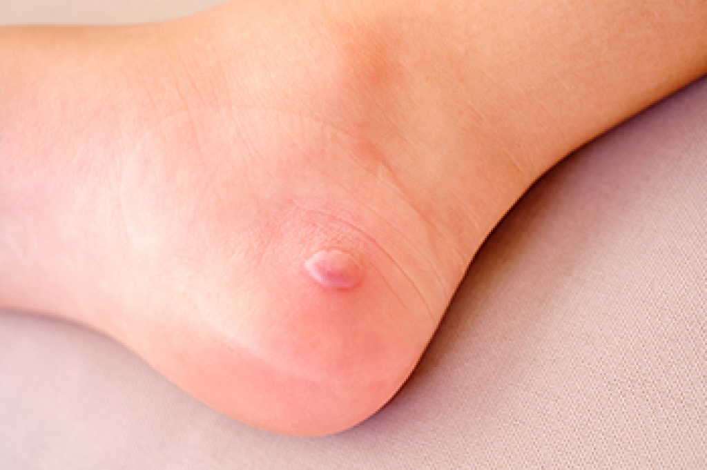 Diabetic Blisters on the Feet