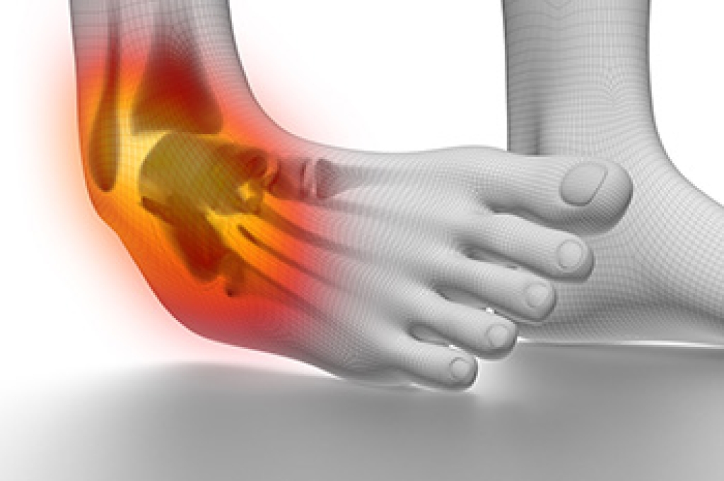 How Acute Ankle Sprains Are Treated