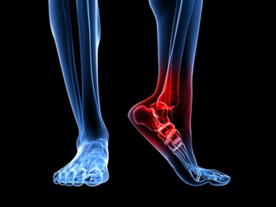 Cureus | A Solitary, Large Calcaneal Osteochondroma Growing Extensively  After Skeletal Maturity: A Case Report and Review of the Literature |  Article