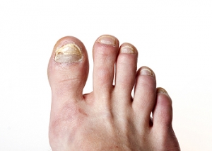 Topical Treatments for Toenail Fungus