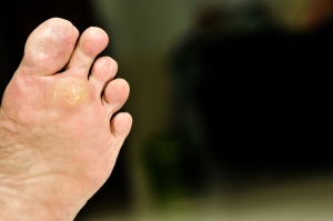 Who Can Get Plantar Warts?
