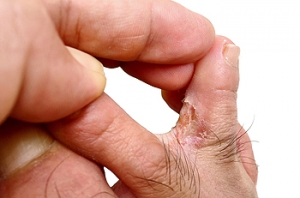 Facts About Athlete’s Foot
