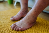 Diabetic Foot Care and Steps to Stay Healthy