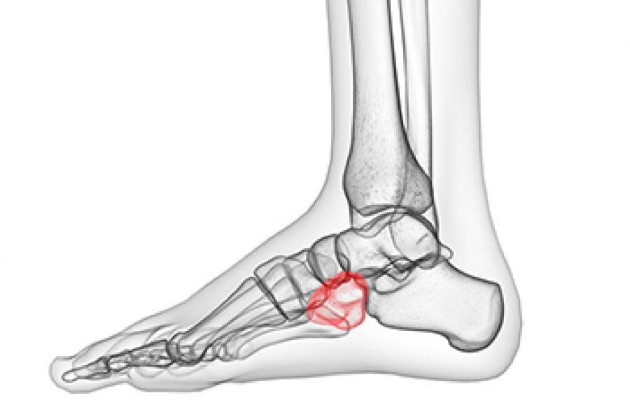 Cuboid Syndrome And Taping