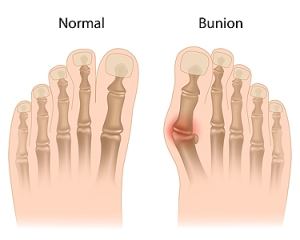 Surgery for Bunions
