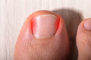 Overcoming an Ingrown Toenail